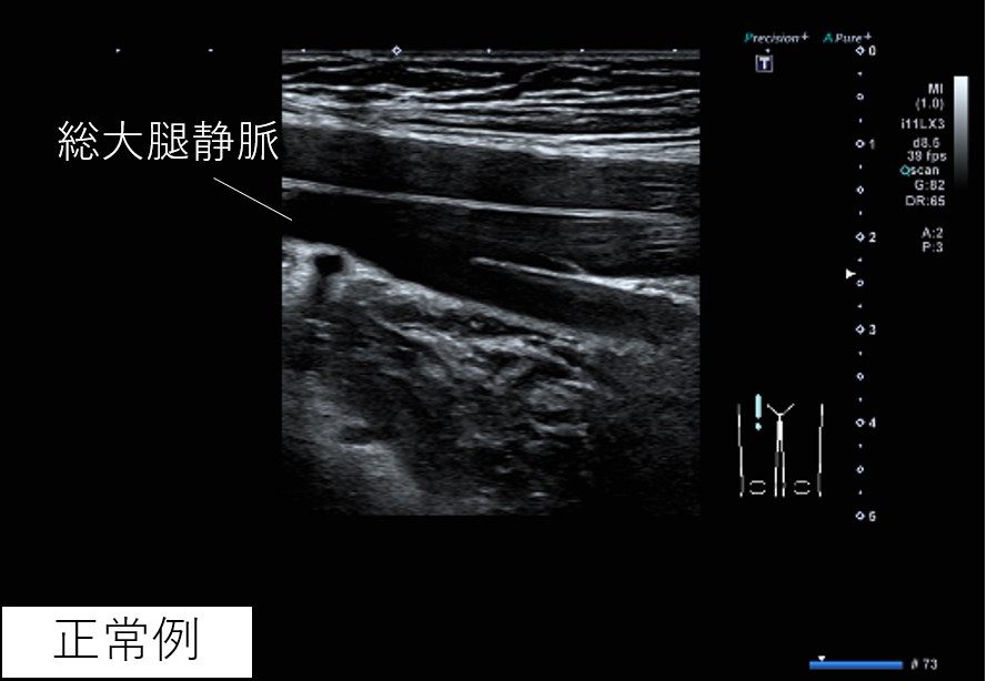 下肢静脈（DVT）エコー | 西宮渡辺心臓脳・血管センター