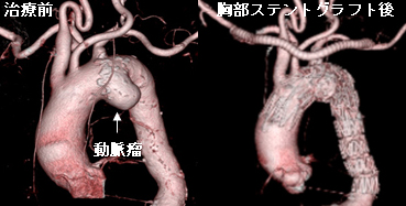 大動脈ステントグラフト血管内治療科 | 西宮渡辺心臓脳・血管センター